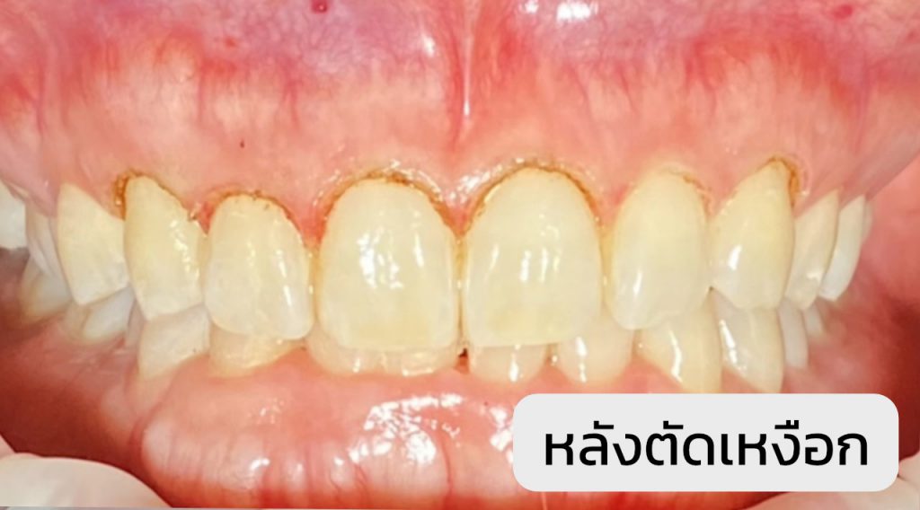 ตัดเหงือก - Tooth Connection Dental Clinic Phuket