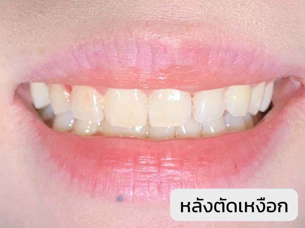 ตัดเหงือก - Tooth Connection Dental Clinic Phuket